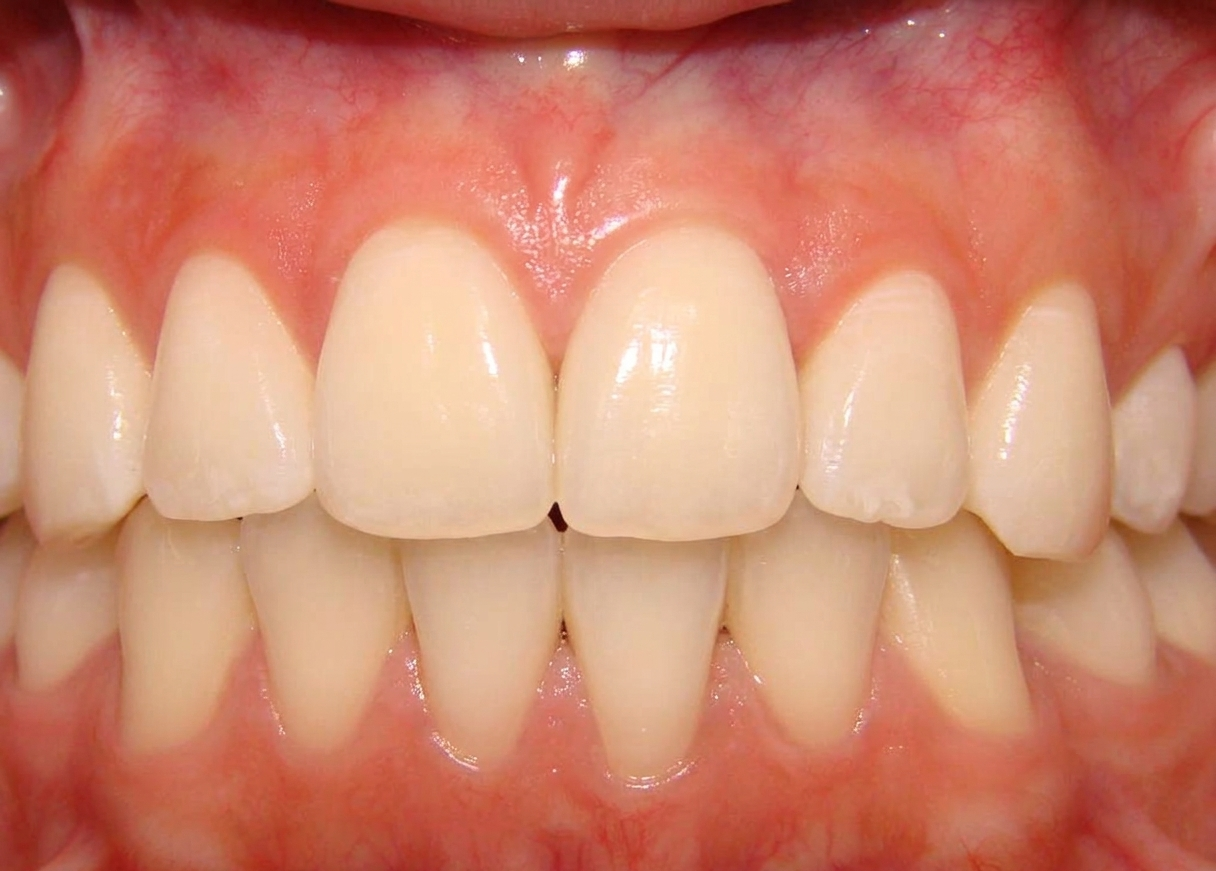 Crown Implant - Final Result