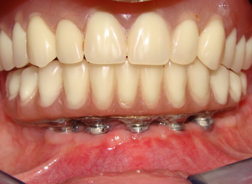 Lower Hybrid - Image 2