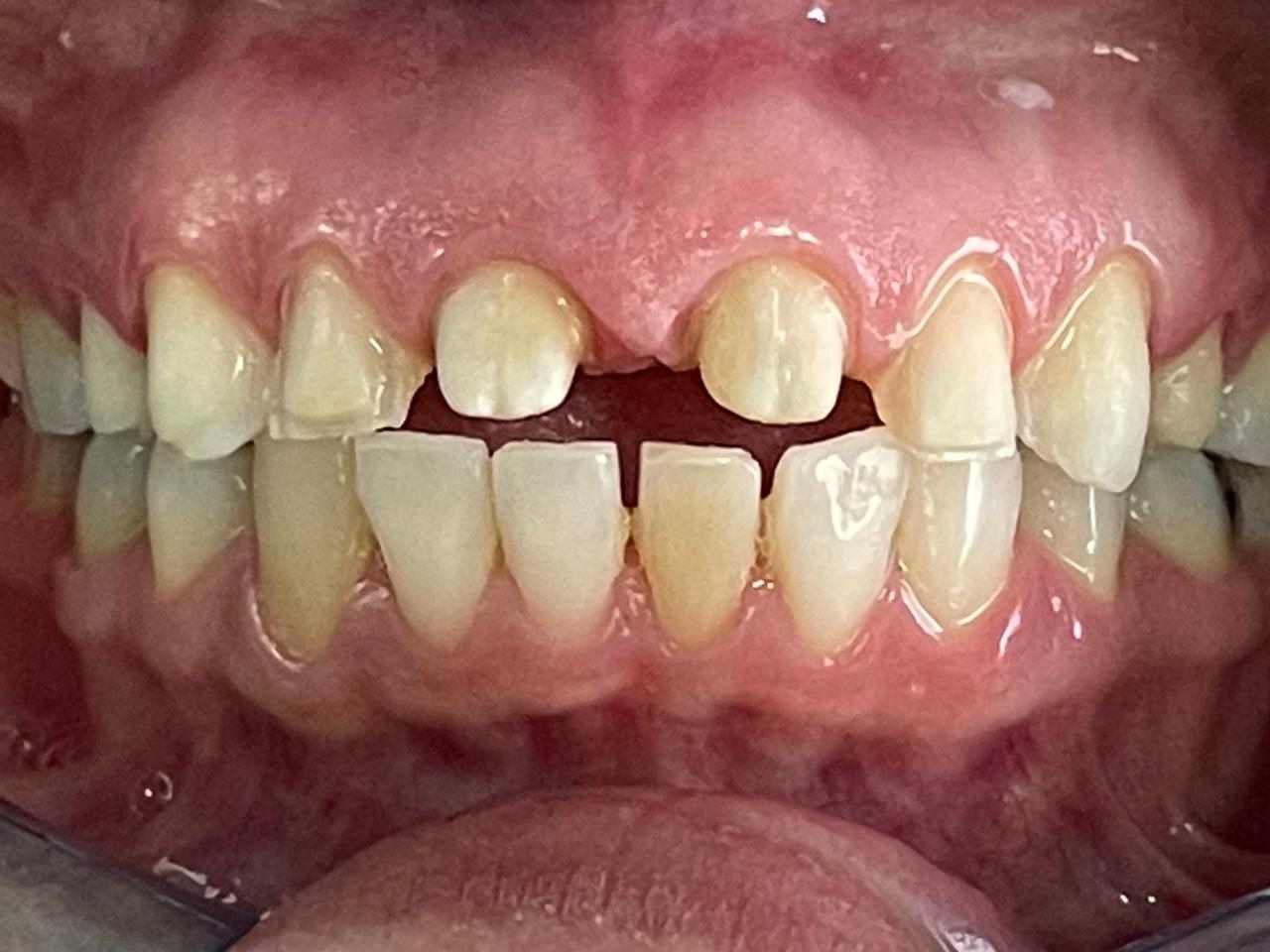Porcelain Veneers - Before