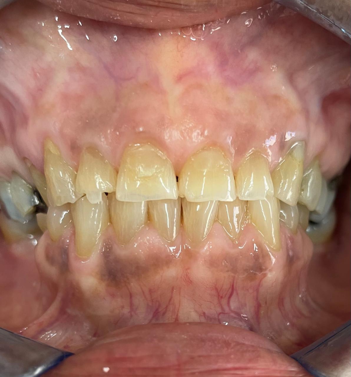 Porcelain Crowns & Resin Veneers - Before
