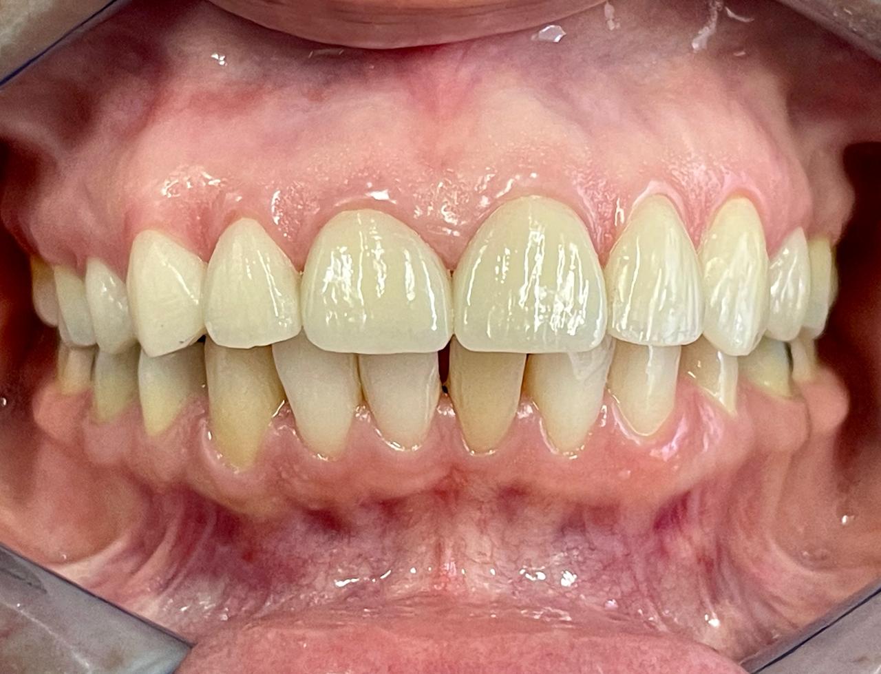 Porcelain Veneers - After
