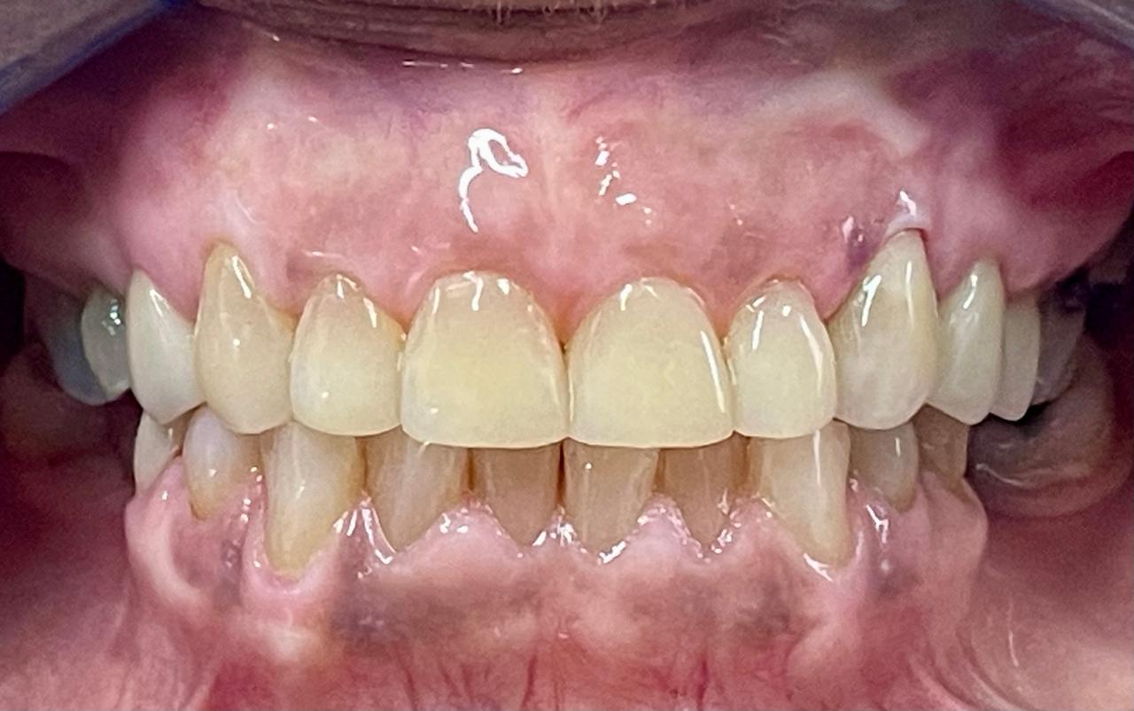 Porcelain Crowns & Resin Veneers - After